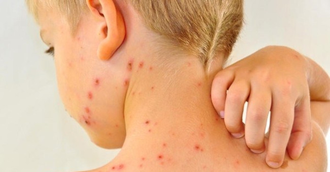 The way of spreading measles