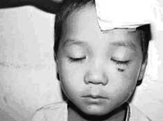 The whole parasite parasites in the human eye for more than 1 year