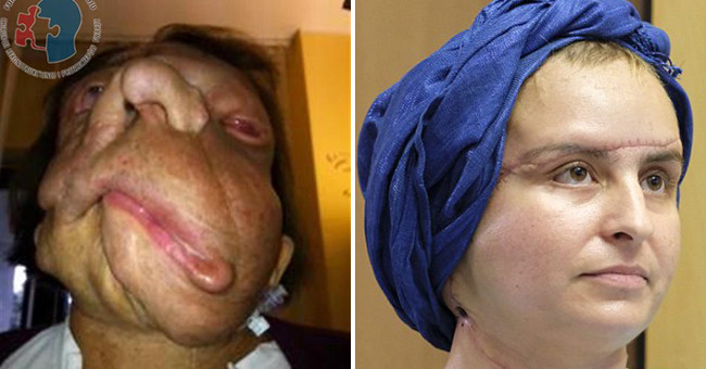 The woman with the devil face became surprisingly beautiful after 3 years