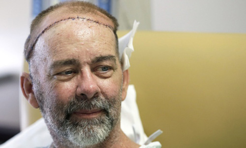 The world's first skull transplant