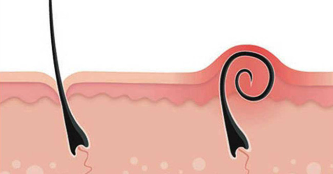 The worrisome consequences of tweezers are tweezers