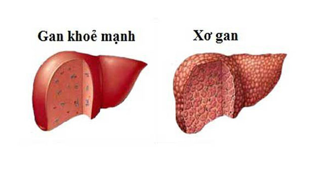 There are several stages in cirrhosis?  What are acute cirrhosis f1, f2, f3, f4?