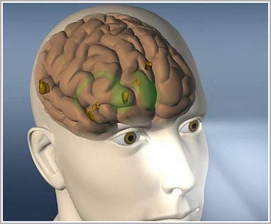 There was the first vaccine against brain cancer