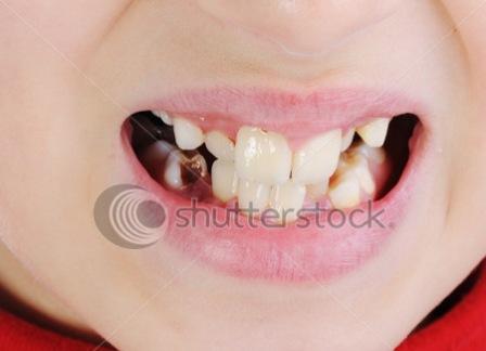 These foods damage teeth