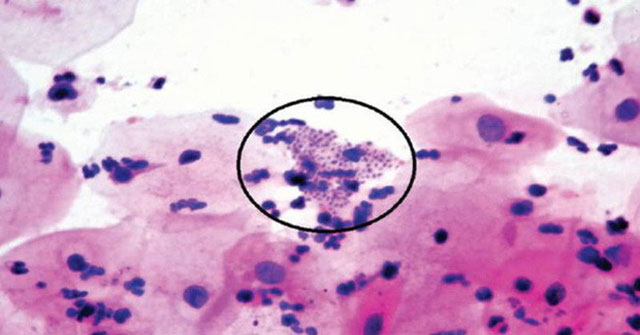 Things to know about sexually transmitted diseases can 'eat people'