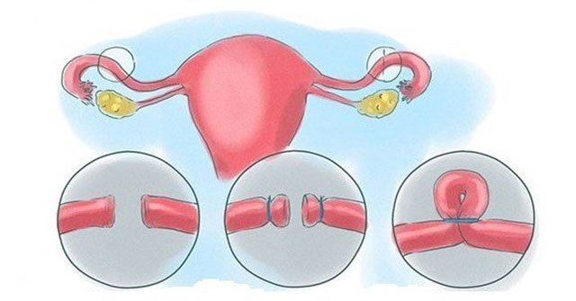 Things to know about sterilization in men and women