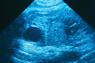 Thrombocytopenia during pregnancy
