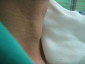 Thyroid cancer: How to detect and treat