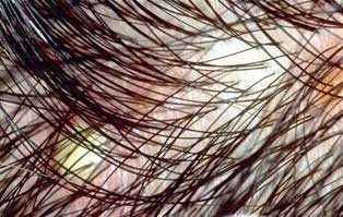 Tips for itching