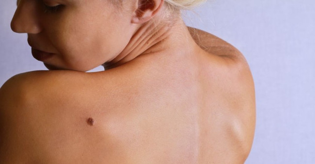 Tips to look at moles to know if cancer is present