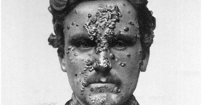 To know how horrible the antibiotic scenario is, go back to the past
