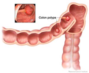 Too little folate can lead to colon cancer.