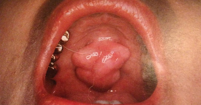 Tooth bone tumors cause many people to fear cancer