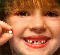 Tooth decay in children