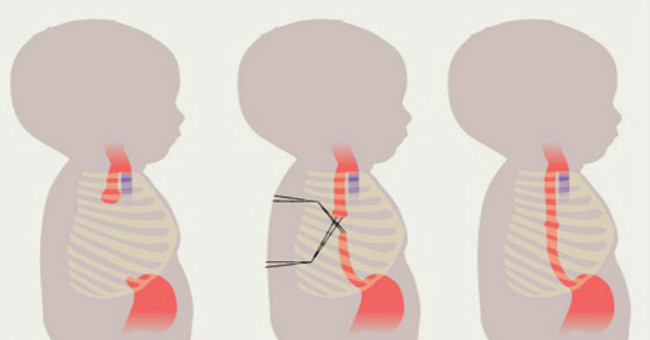 Transplant the robot into the infant's body to cure it