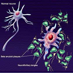 Treat Alzheimer's with nano gold particles
