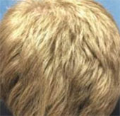 Treat baldness with arthritis medicine