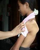 Treat Delta muscle atrophy by physiotherapy