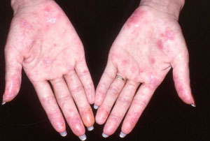 Treat lupus with stem cells
