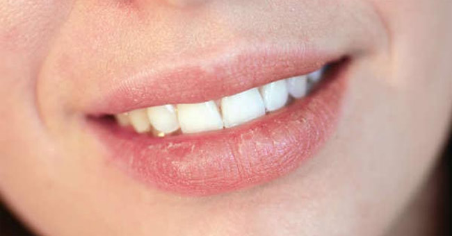 Treating lips cracked
