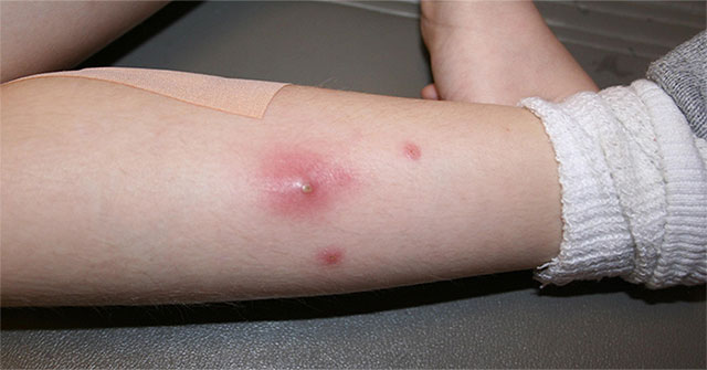 Treatment for swollen pimples