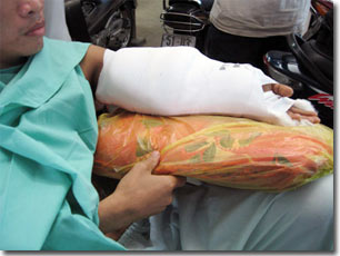 Treatment of bone fractures with stem cells