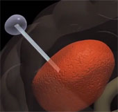 Treatment of brain tumors using technology