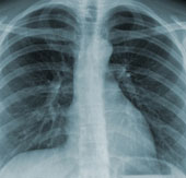 Tuberculosis testing without X-ray is a new device