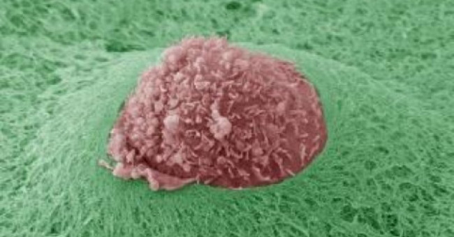 Tumor metastasis formation like?