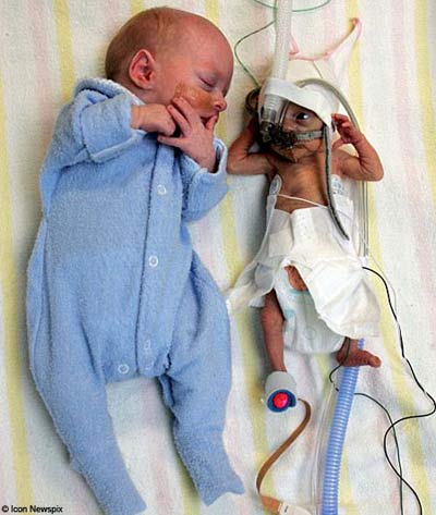 Twin births