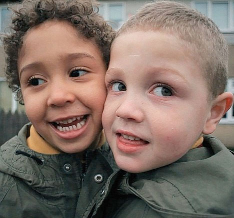 Twins are different in skin color