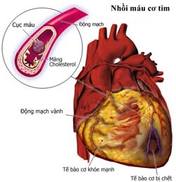 Two more genes related to heart disease were discovered