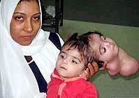Two-headed baby girl died of infection