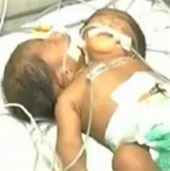 Two-headed boys are born in India