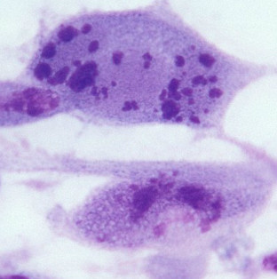 Two-thirds of the world's population is infected with sexually transmitted viruses