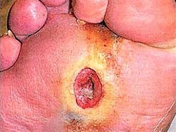 Ulcers in diabetics: Treating with honey?