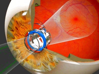 Ultra-small telescope helps improve vision