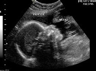 Ultrasound affects the developing brain