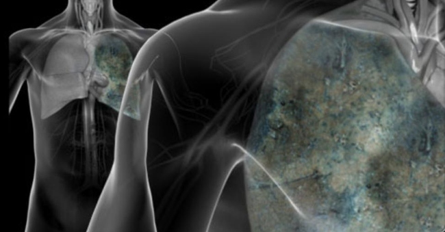 Understanding pleurisy cancer Meritorious patient Han Van Tinh