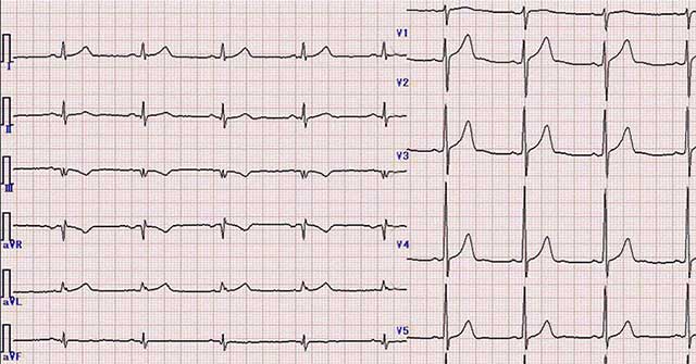 Unknown things about ECG