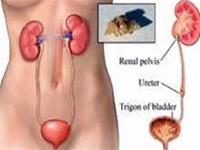 Urinary stones and dangerous complications