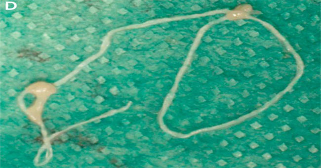 Use a selfie to keep track of 'parasitic worms' moving back and forth on the face for 2 weeks