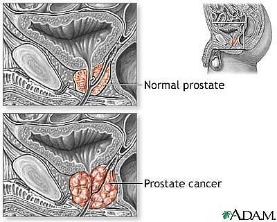 Use immunity to reduce prostate cancer risk
