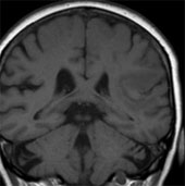 Use 'sex virus' to kill brain tumors