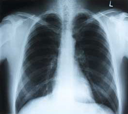 Useless antibiotics with most cases of bronchitis