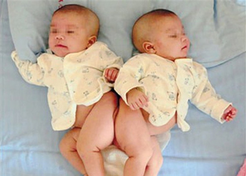 Using 3D technology to recreate conjoined twins body parts