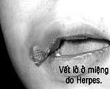 Using a cold towel may cause lip sores