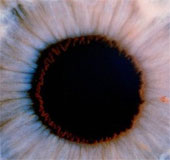 Using stem cells in the treatment of blindness