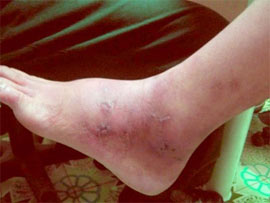 Varicose veins of legs: Common disease in older women