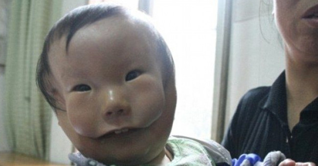 Very rare deformities, babies carry two faces